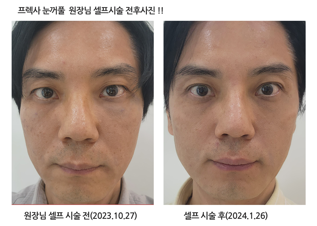 프렉사 상세 안내 이미지 1